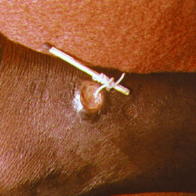 Infekce vlasovcem medinským je díky filtraci vody téměř vymýcená. 