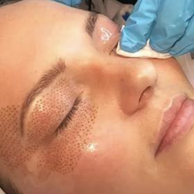 Metoda omlazení pomocí plasmového pera spočívá v řadě drobných vpichů, které v pokožce stimulují přirozenou obnovu tvorby kolagenu.