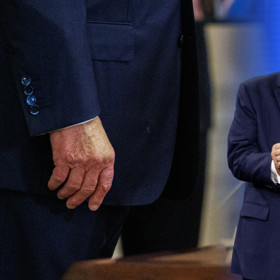 Donald trump má chronickou žilní nedostatečnost.