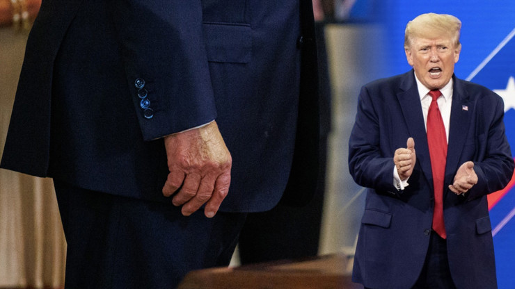Donald trump má chronickou žilní nedostatečnost.