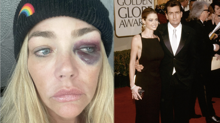 Denise Richards má monokly.