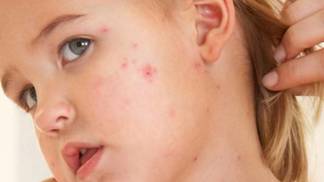 Epidemie spalniček ohrožuje Česko! Jak jste na tom s protilátkami, prozradí rychlý test