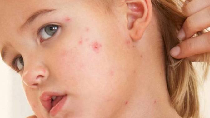 Onemocnění se projeví asi 10-12 dní po nákaze zvýšenou teplotou, rýmou, kašlem, slzením očí – a po dalších asi 3-7 dnech i následnou červenou vyrážkou, která přetrvává asi týden