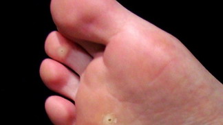 Kuří oka vznikají z nepohodlné obuvi