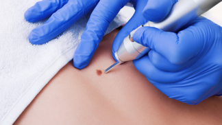 Pihy si můžete nechat odstranit různými způsoby.