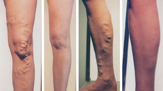 Strašák jménem křečové žíly: Mýty a pravda ohledně prevence i léčby