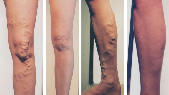 Strašák jménem křečové žíly: Mýty a pravda ohledně prevence i léčby