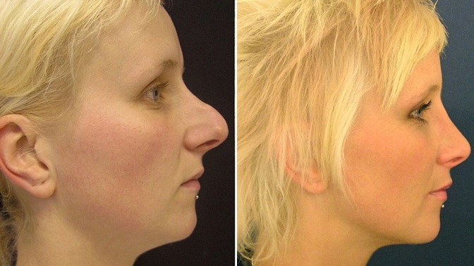 Docent Měšťák: Plastika nosu vám může změnit život, stanete se pro všechny jiným člověkem