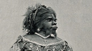 Julia Pastrana (1834 – 25. březen 1860) byla mexická zpěvačka a umělkyně, která trpěla vzácnou nemocí hypertrichózou. Ta se projevuje nadměrným růstem ochlupení. Pacientům postiženým touto chorobou se dříve říkalo vlčí či vlkodlačí lidé.