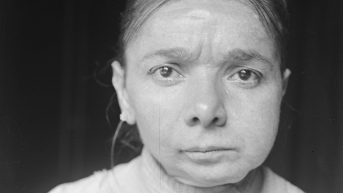 Temná historie výroby zápalek: Děvčatům z továren hnily tváře zaživa