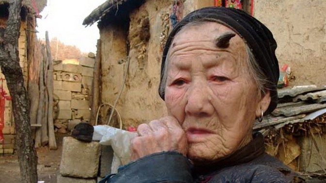 Lidský jednorožec: Číňanu Wangovi vyrostl na hlavě 35 centimetrů dlouhý roh, nakonec se po něm slehla zem