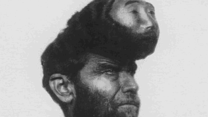 Dvouhlavý Pasqual Piñón: Co se doopravdy urývalo za jeho bizarní deformací?