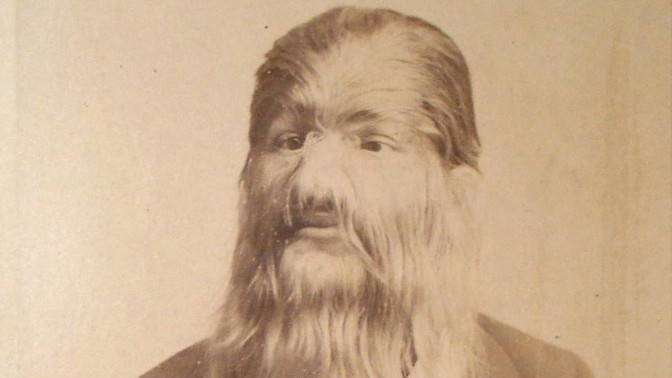 Chlupatá hvězda cirkusu: Fedor Jeftichew trpěl hypertrichózou, zdědil ji po otci