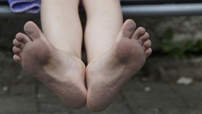 Nezvyklou barvu ale může způsobit i ekzém