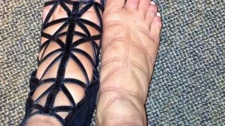 Oteklé nohy jsou nevzhledné.