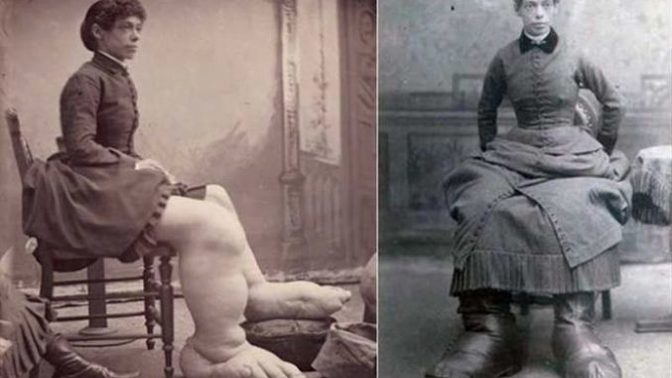 Žena s největšími chodidly na světě.