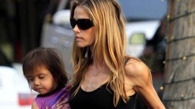 Denise Richards kvůli anorexii ztratila svou pověstnou krásu.