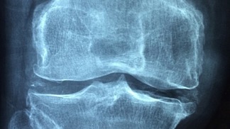 Starší kosti a klouby potřebují speciální péči.