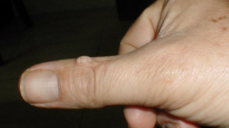 Bradavice jsou nepříjemné.