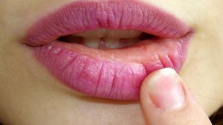 Afty pálí a jsou velmi nepříjemné.