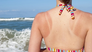 Produkty z drogerie neúčinkují. Na spálenou kůži zkuste mléko a aspirin, radí dermatoložka