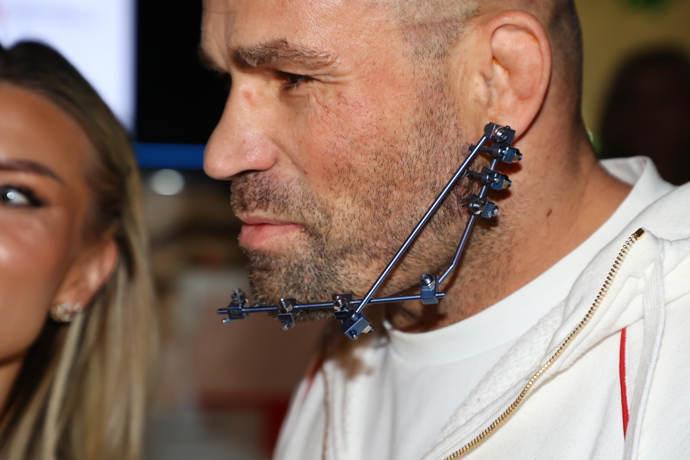 Karlos Vémola má na čelisti speciální přístroj.