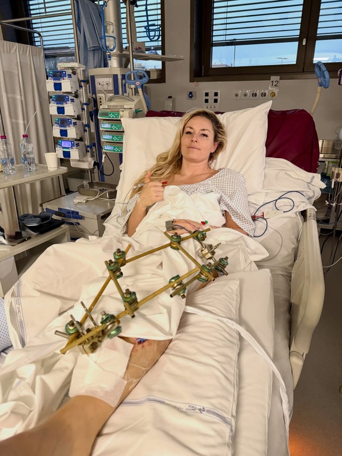 Lindsey Vonn sdílela na Instagramu první snímky z nemocnice. Na levé noze má obrovskou kovovou konstrukci. Lyžařka podstoupila už tři operace. 