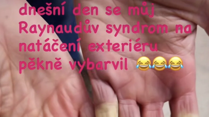FOTO: Ivana Jirešová má tzv. Raynaudův syndrom.