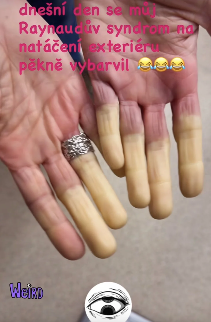 Ivana Jirešová má tzv. Raynaudův syndrom.