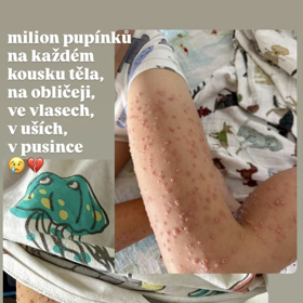 Malý Oliver má agresivní formu neštovic.