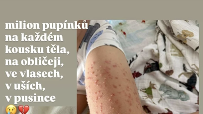 FOTO: Malý Oliver má agresivní formu neštovic.