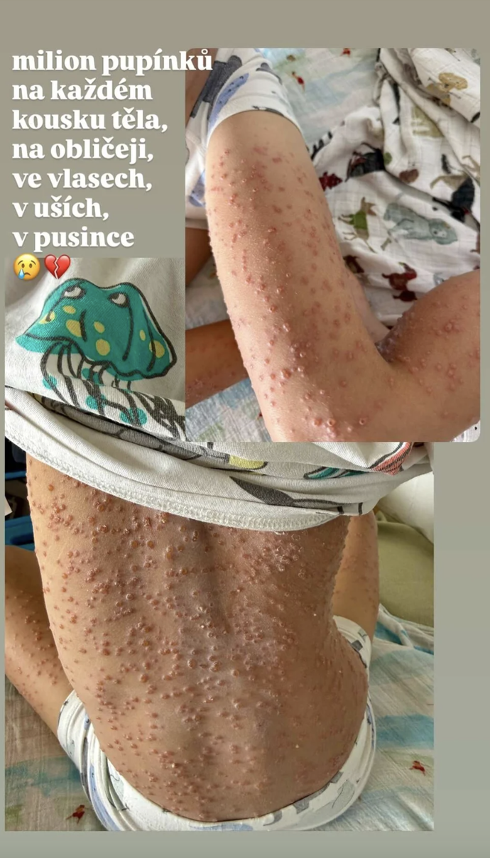 Malý Oliver má agresivní formu neštovic.