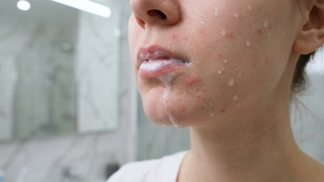 Trápí vás věčné akné na bradě? Za vaše pupínky může tato banální chyba, kterou v koupelně dělá skoro každý