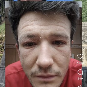 Jan Solfronk v době, kdy byl jeho stav velmi vážný.