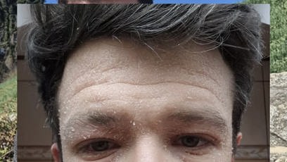 FOTO: Jan Solfronk v době, kdy byl jeho stav velmi vážný.