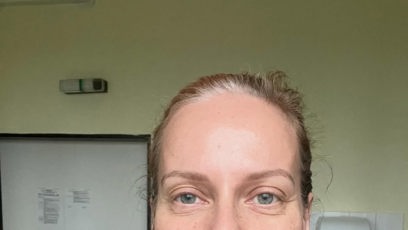 FOTO: Kristina Kloubková ukázala jizvu po operaci.