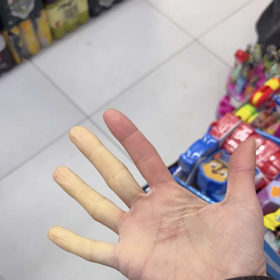 Aneta Vignerová má takzvaný Raynaudův syndrom.