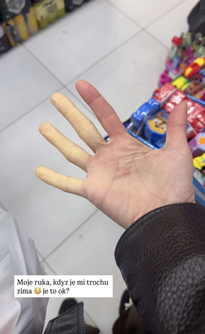 Aneta Vignerová má takzvaný Raynaudův syndrom.