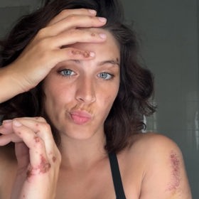 Paulína Bošková už se z nehody zotavuje.