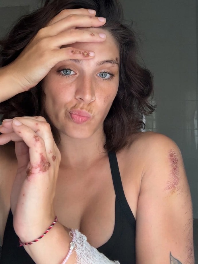 Paulína Bošková už se z nehody zotavuje.