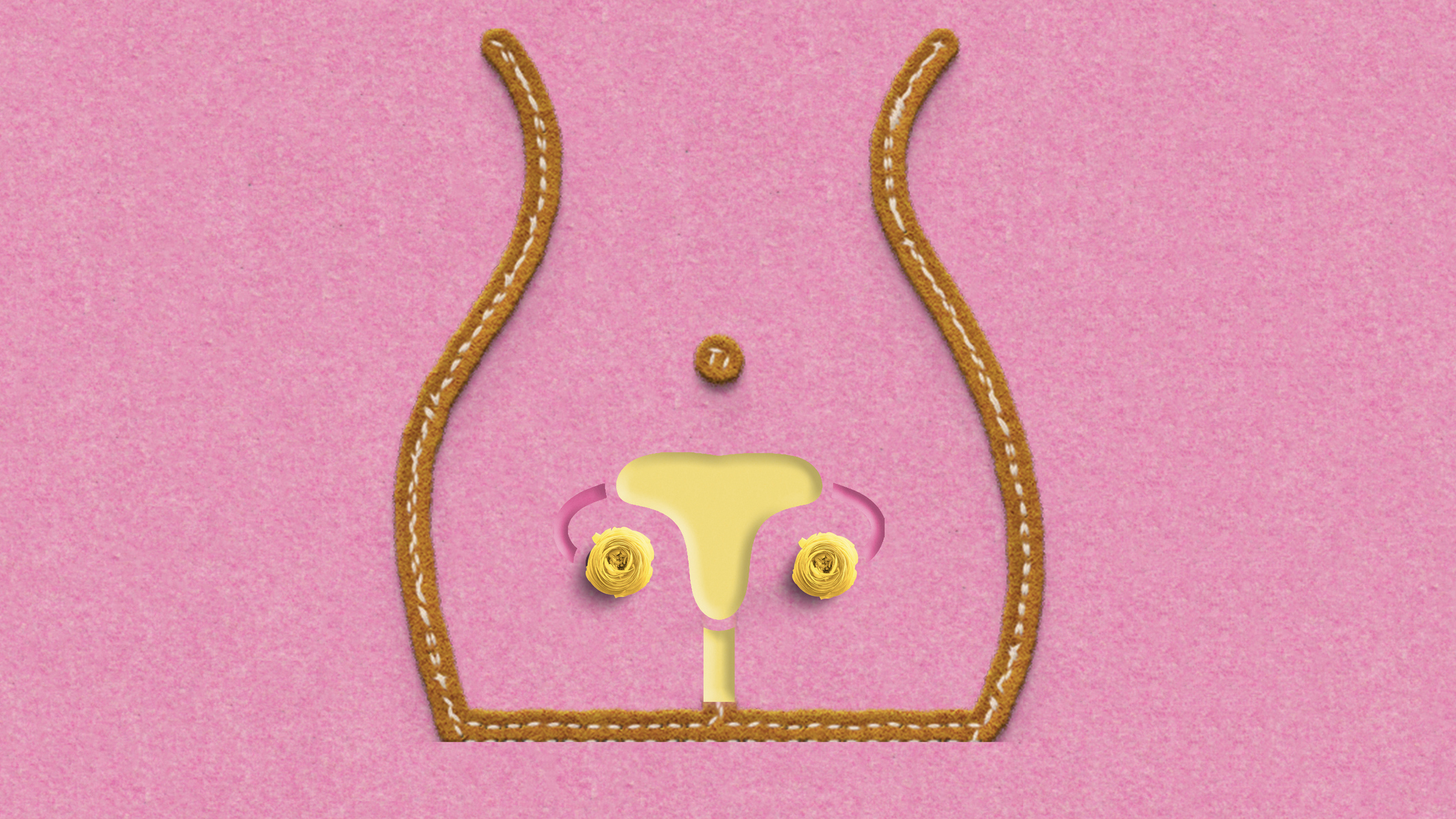 PCOS