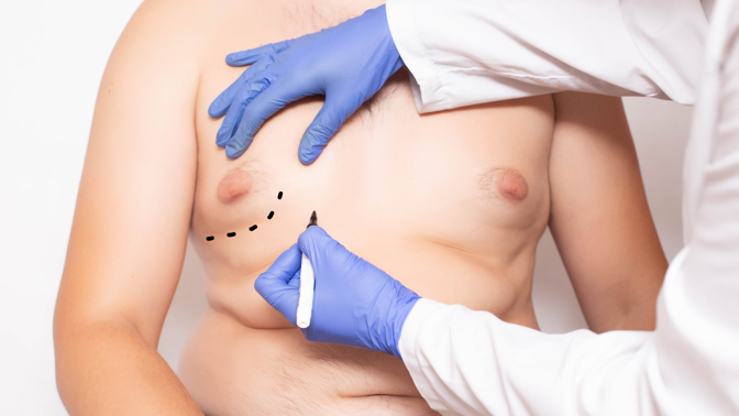 muž s gynekomastií u plastického lékaře