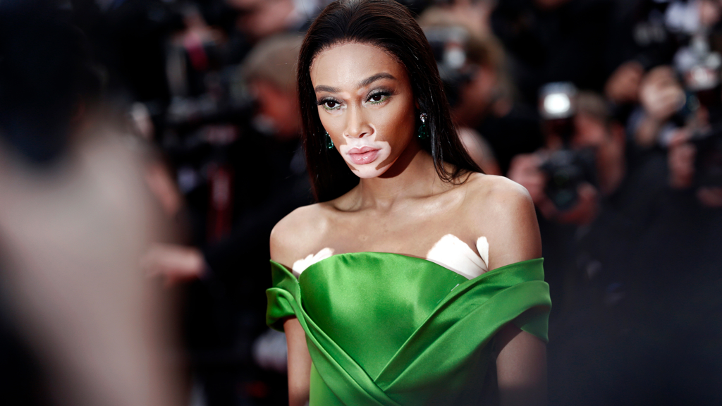 Winnie Harlow