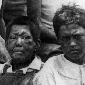 Havajští chlapci s malomocenstvím, infekčním onemocněním způsobovaným bakterií Mycobacterium leprae, která napadá periferní nervy, kůži a sliznice.