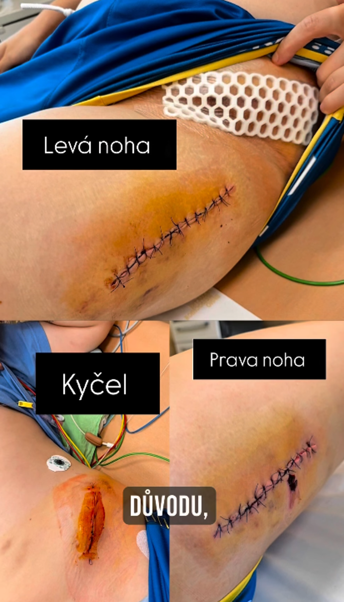 Adam Choma podstoupil další operaci.
