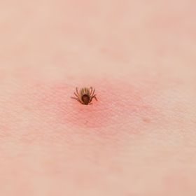 Klíště může na kůži zůstat dlouho bez povšimnutí, zvlášť pokud se přisaje na špatně viditelném místě. Čím dříve ho objevíte a správně odstraníte, tím více snižujete riziko přenosu lymské boreliózy.