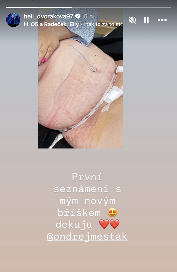 Helena Dvořáková z Extrémních proměn ukázala nové břicho.