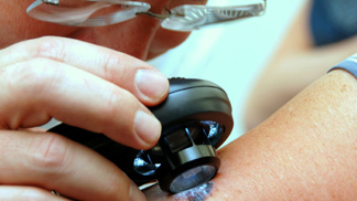 Stop melanomu! Nechte si v sobotu vyšetřit znaménka