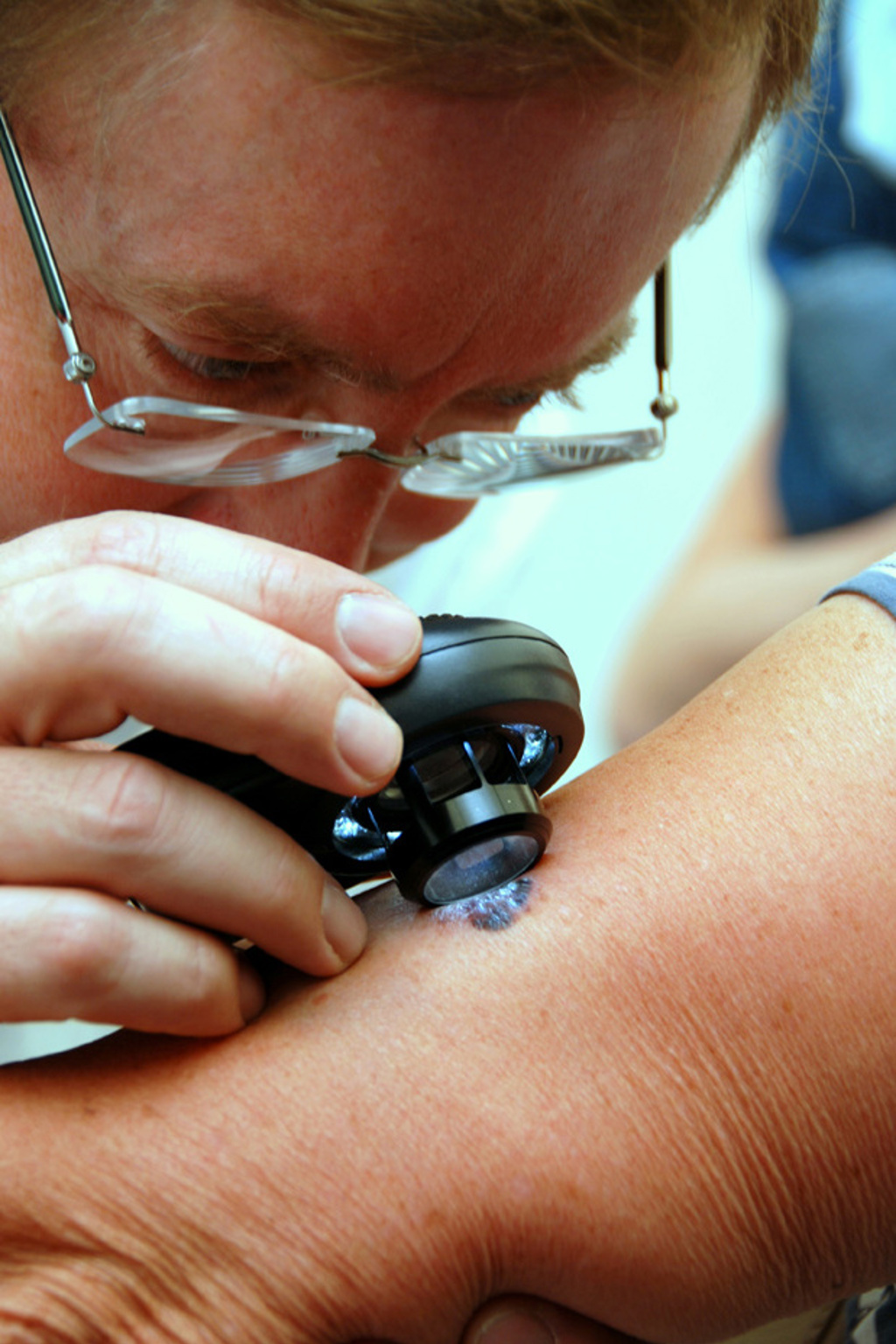 Stop melanomu! Nechte si v sobotu vyšetřit znaménka Stop melanomu! Nechte si v sobotu vyšetřit znaménka