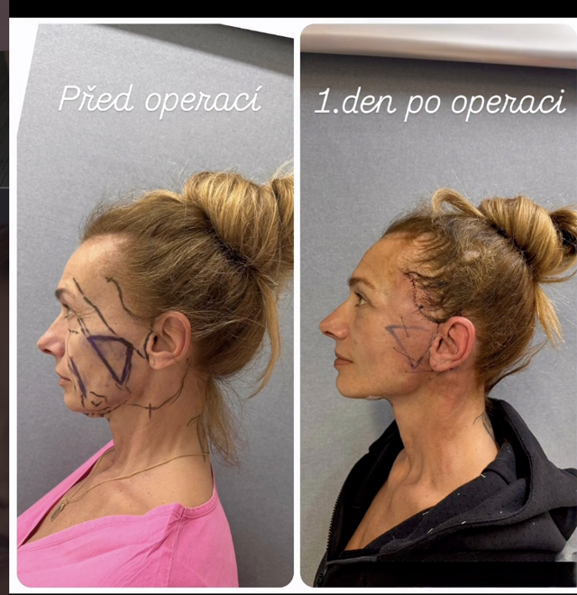 Všechno, co potřebujete vědět o deep plane faceliftu, zákroku, který viditelně omladil Alici Bendovou
